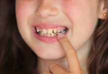 Jeder dritte Erstklässler in Ostholstein hat bereits Zahnfüllungen