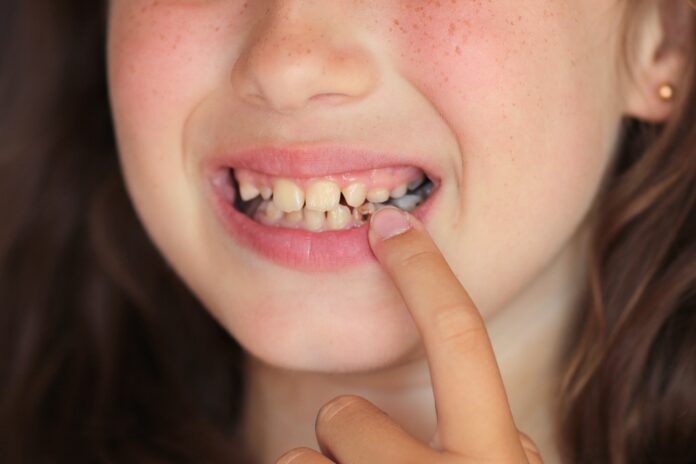 Zahnfüllungen-Kinder