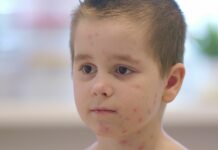 Windpockenfälle im Kreis Ostholstein nehmen zu