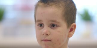 Windpockenfälle im Kreis Ostholstein nehmen zu